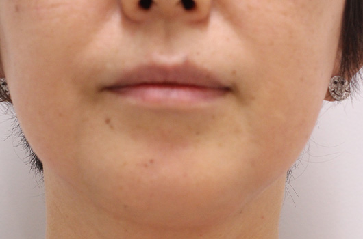 ほうれい線,口の周りの症例写真（Before）／40代 女性