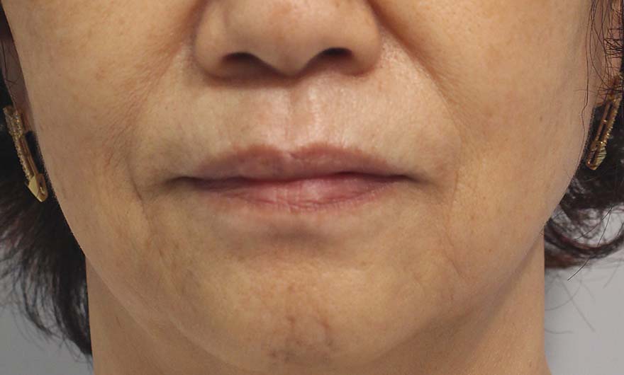 口の周りの症例写真（After）／70代 女性