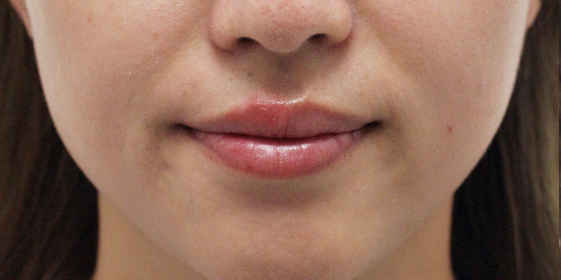 口の周りの症例写真（After）／30代 女性