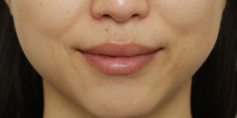 口の周りの症例写真（Before）／30代 女性