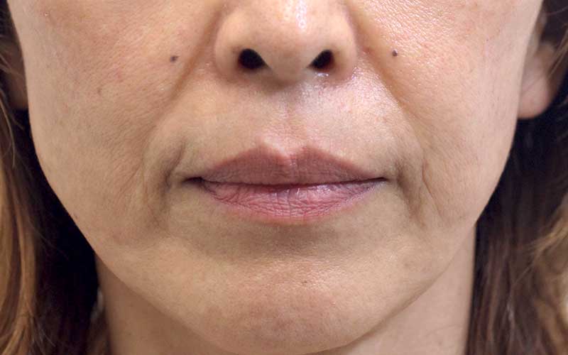 口の周りの症例写真（After）／50代 女性