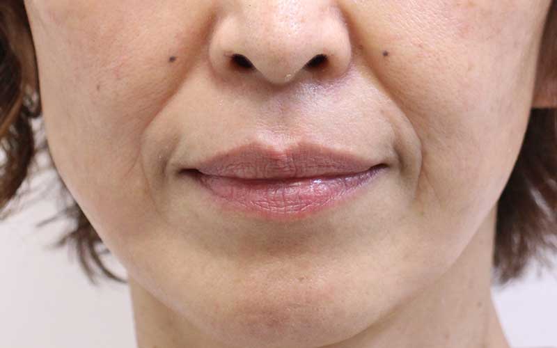 口の周りの症例写真（Before）／50代 女性