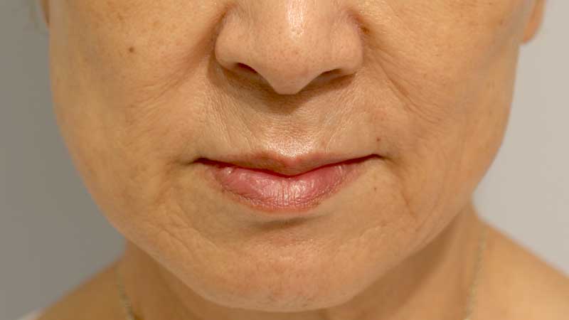 口の周りの症例写真（After）／60代 女性