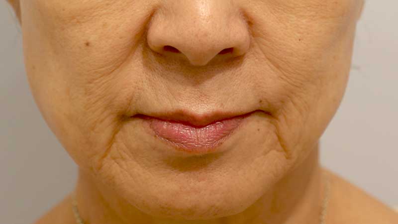 口の周りの症例写真（Before）／60代 女性
