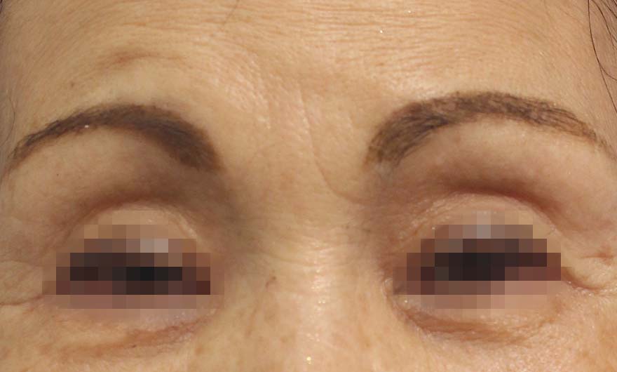 眉間の症例写真（After）／70代 女性