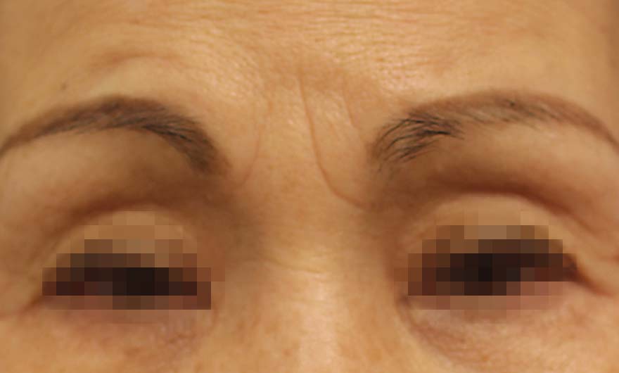 眉間の症例写真（Before）／70代 女性