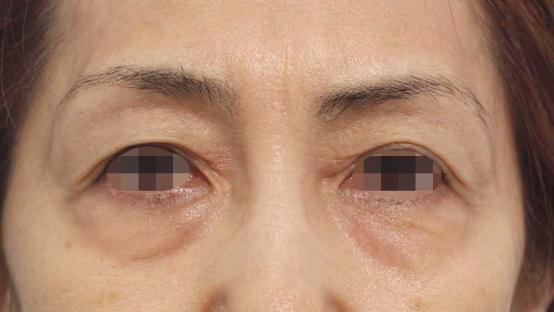 眉間,目の周りの症例写真（After）／60代 女性