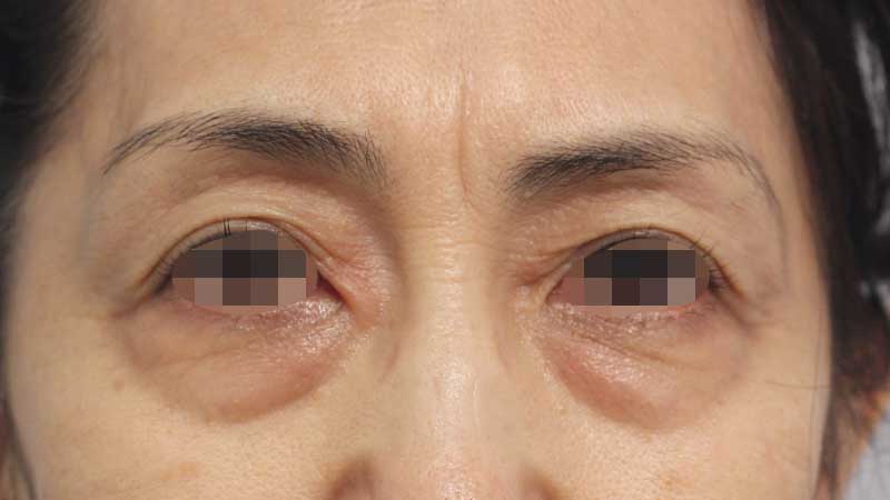 眉間,目の周りの症例写真（Before）／60代 女性