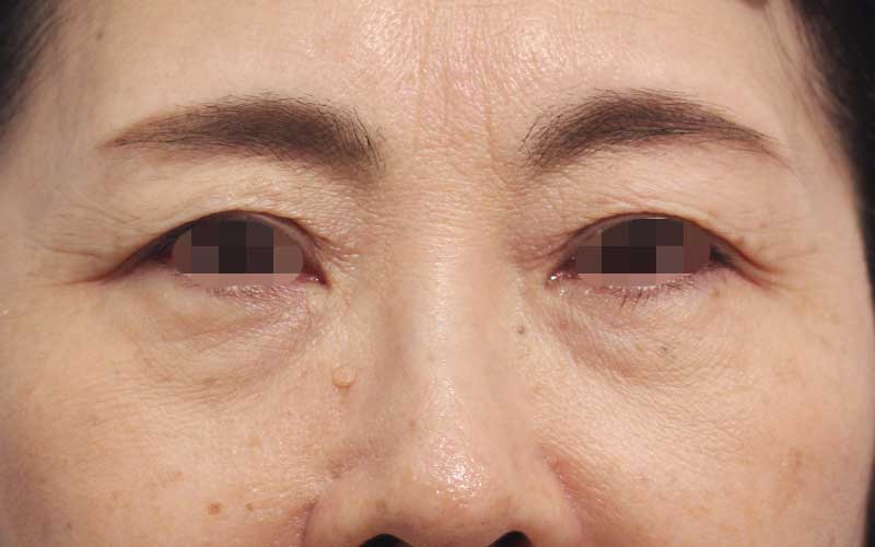 眉間,目の下のクマの症例写真（After）／60代 女性