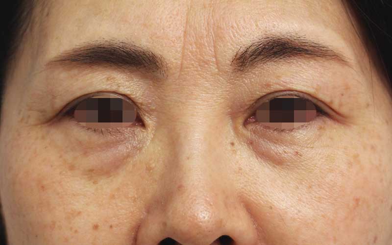 眉間,目の下のクマの症例写真（Before）／60代 女性