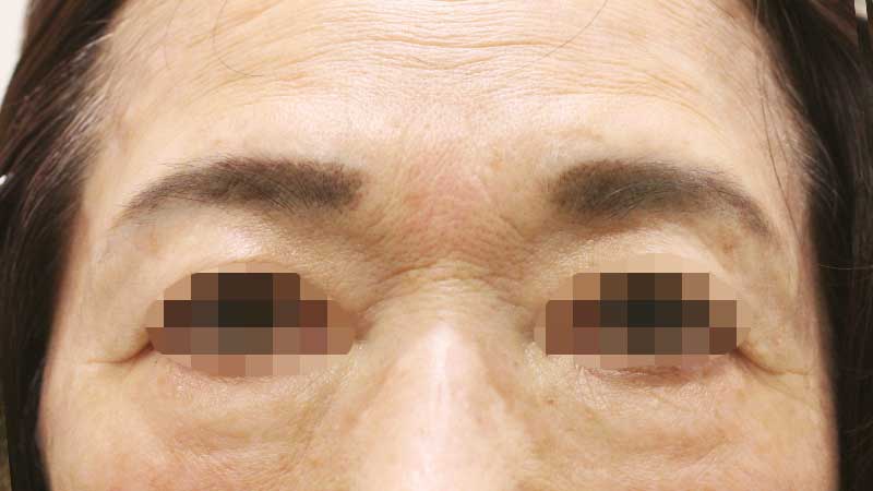 眉間の症例写真（After）／70代 女性