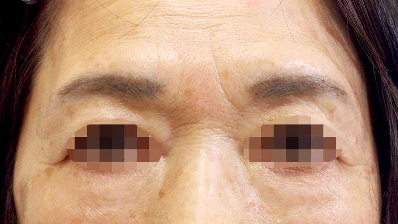 眉間の症例写真（Before）／70代 女性