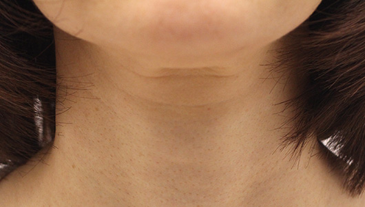 首の症例写真（After）／40代 女性