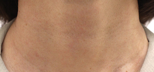 首の症例写真（Before）／40代 女性