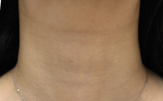 首の症例写真（Before）／40代 女性