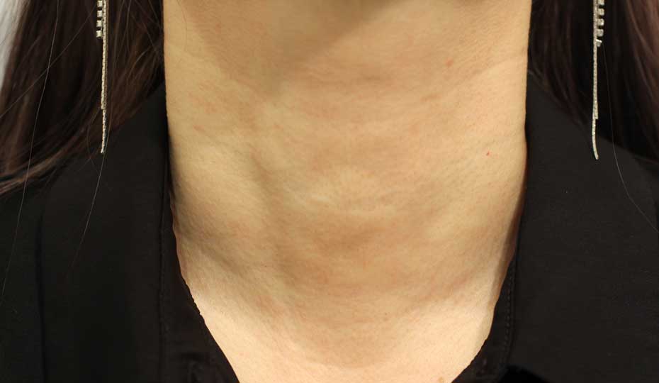 首の症例写真（After）／50代 女性