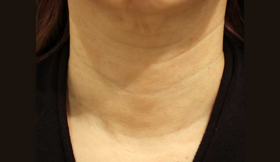 首の症例写真（Before）／50代 女性
