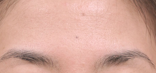 おでこのシワの症例写真（After）／40代 女性