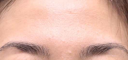おでこのシワの症例写真（Before）／40代 女性