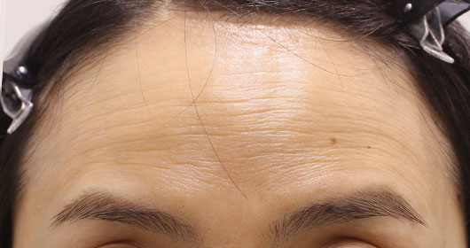 おでこのシワの症例写真（After）／50代 女性