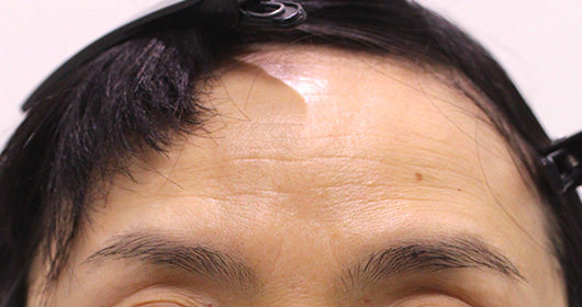 おでこのシワの症例写真（Before）／50代 女性