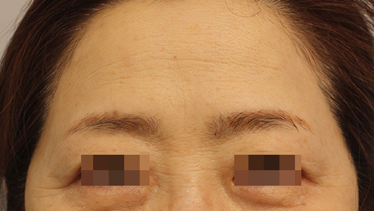 おでこのシワの症例写真（After）／60代 女性