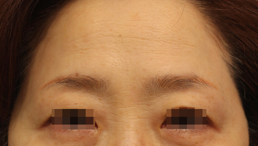 おでこのシワの症例写真（Before）／60代 女性