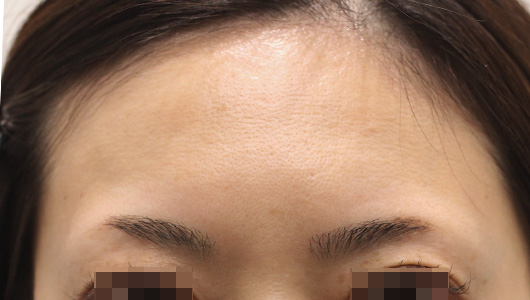 おでこのシワの症例写真（After）／30代 女性