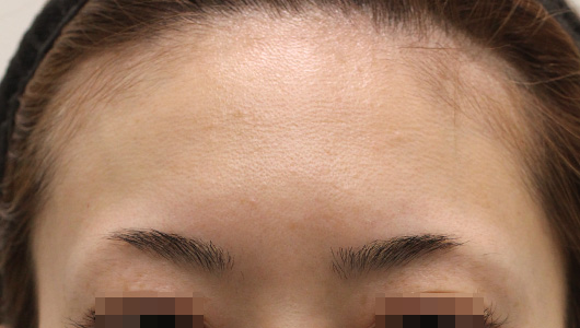 おでこのシワの症例写真（Before）／30代 女性