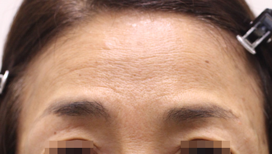 おでこのシワの症例写真（After）／50代 女性