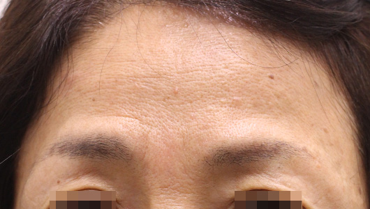 おでこのシワの症例写真（Before）／50代 女性
