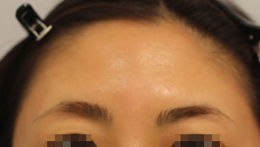 おでこのシワの症例写真（Before）／40代 女性