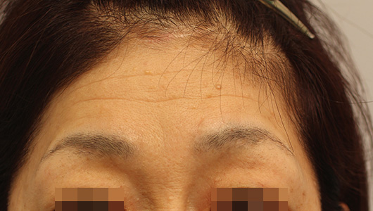 おでこのシワの症例写真（Before）／50代 女性