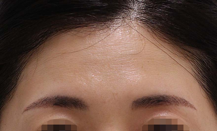 おでこのシワの症例写真（After）／40代 女性