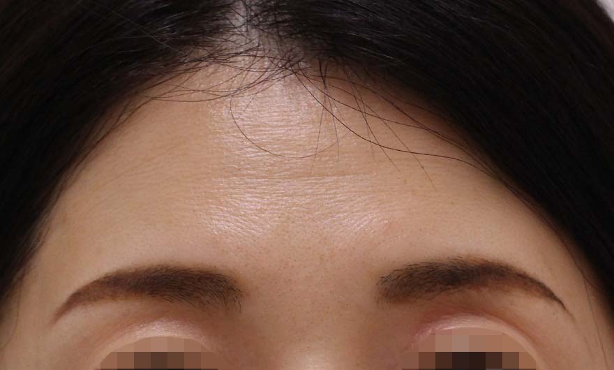 おでこのシワの症例写真（Before）／40代 女性