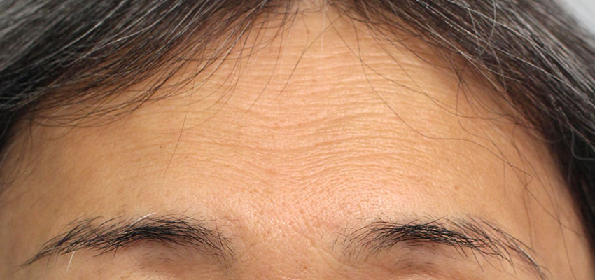 おでこのシワの症例写真（After）／60代 女性