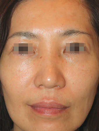 顔全体の症例写真（After）／50代 女性