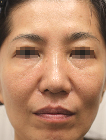 顔全体の症例写真（Before）／50代 女性