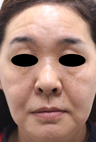 顔全体の症例写真（After）／50代 女性