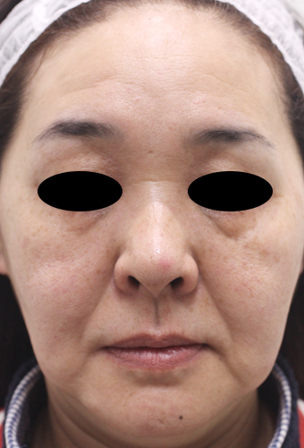 顔全体の症例写真（Before）／50代 女性