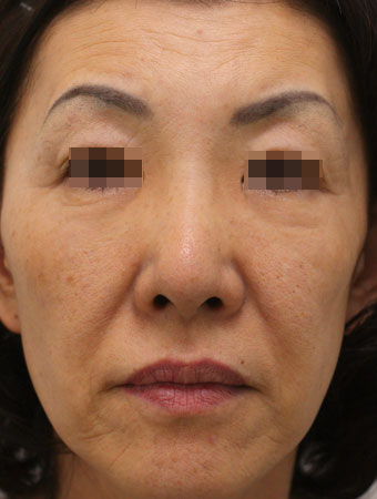 顔全体の症例写真（After）／50代 女性