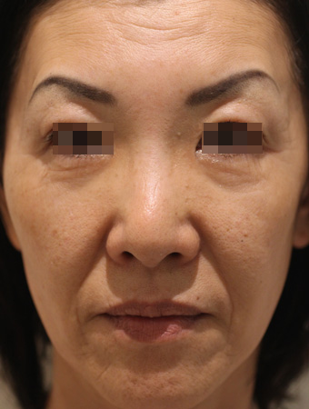 顔全体の症例写真（Before）／50代 女性