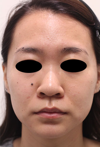 顔全体の症例写真（After）／20代 女性