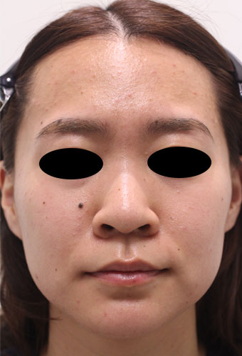 顔全体の症例写真（Before）／20代 女性