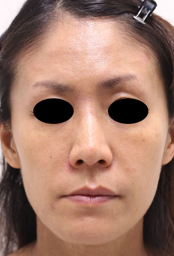 顔全体の症例写真（After）／40代 女性