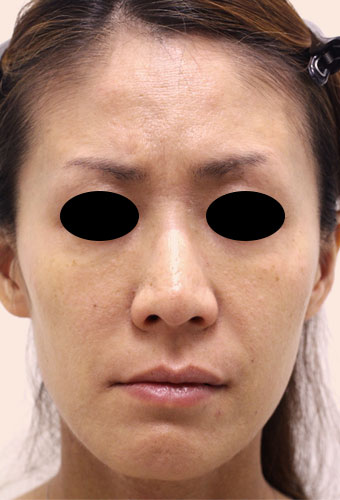 顔全体の症例写真（Before）／40代 女性