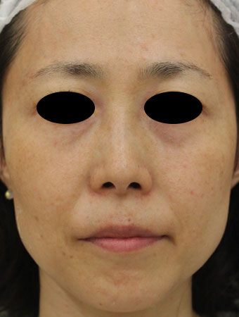 顔全体の症例写真（After）／40代 女性
