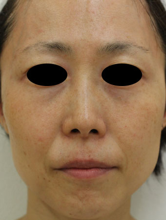 顔全体の症例写真（Before）／40代 女性