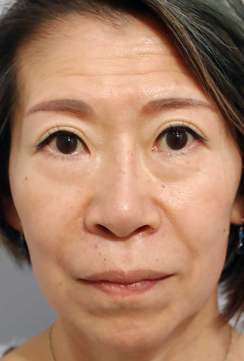 顔全体の症例写真（After）／50代 女性