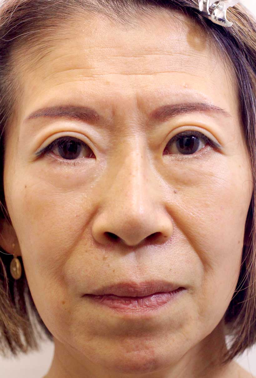 顔全体の症例写真（Before）／50代 女性